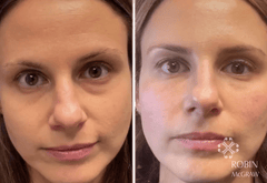 Bright Eye Miracle - Instant Under Eye Bag Removal Cream